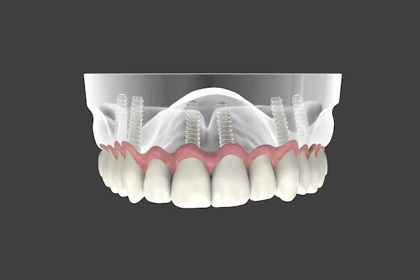 Are Implant Supported Dentures Permanent from All Smiles Dental Center in San Antonio, TX