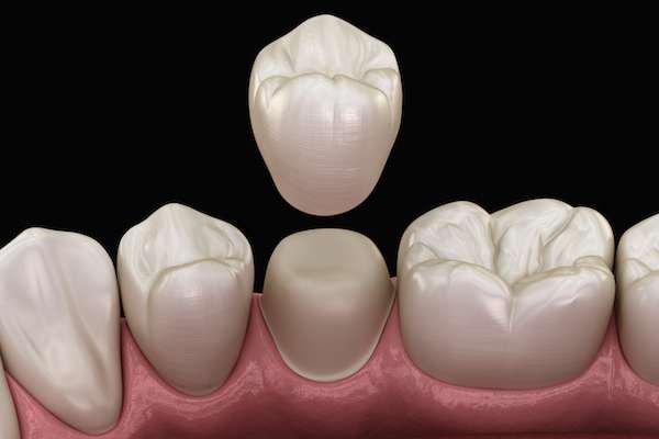 What To Ask Your General Dentist When Preparing for a Crown from All Smiles Dental Center in San Antonio, TX