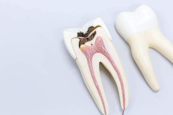 Ask a General Dentist: Is a Tooth Dead After a Root Canal from All Smiles Dental Center in San Antonio, TX