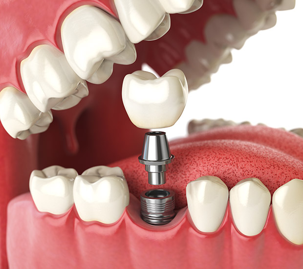 San Antonio Will I Need a Bone Graft for Dental Implants