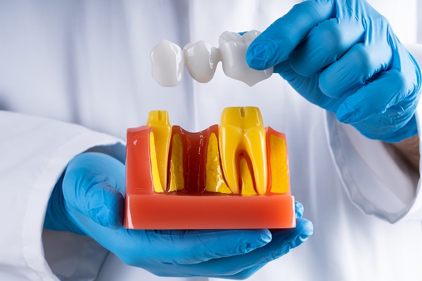 How Dental Bridges Can Improve Your Smile