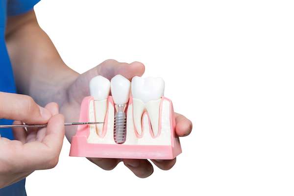 Can You Get Dental Implants if You Have Gum Disease from All Smiles Dental Center in San Antonio, TX