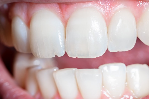 How A Dentist Can Treat A Chipped Tooth