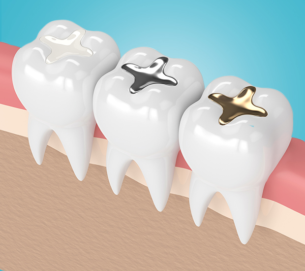 San Antonio Composite Fillings