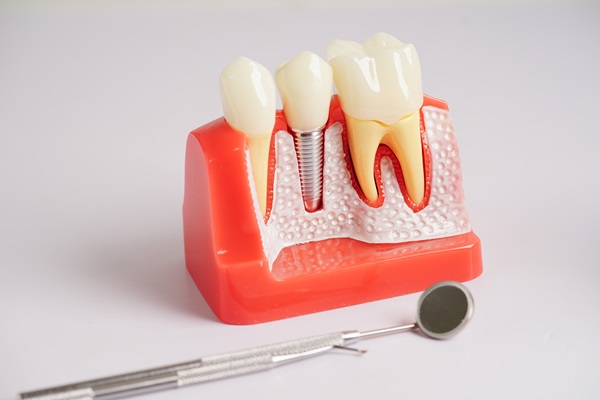 When A Dental Crown May Need To Be Replaced