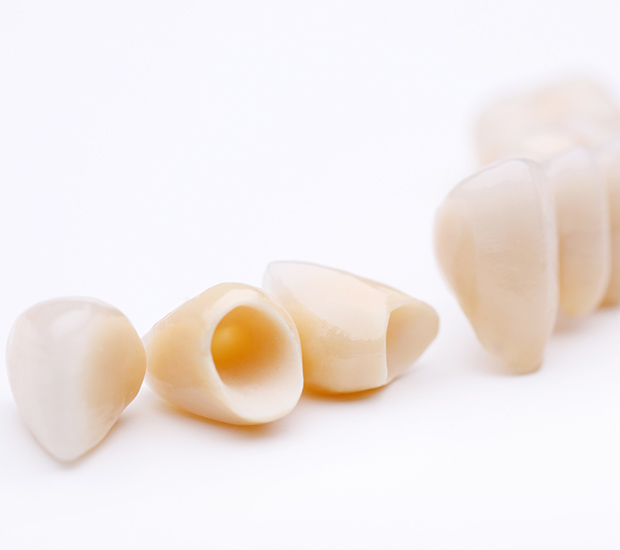 San Antonio Dental Crowns and Dental Bridges