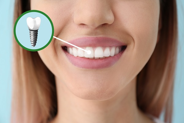 The   Parts Of Dental Implant Tooth Replacement