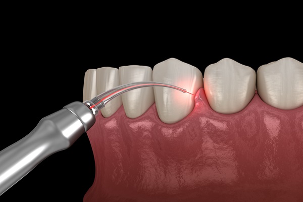 Types Of Treatment For Gum Disease