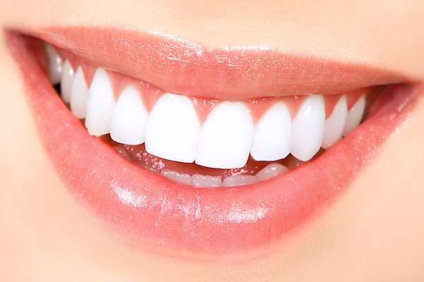 How Long Does Teeth Whitening Take from All Smiles Dental Center in San Antonio, TX