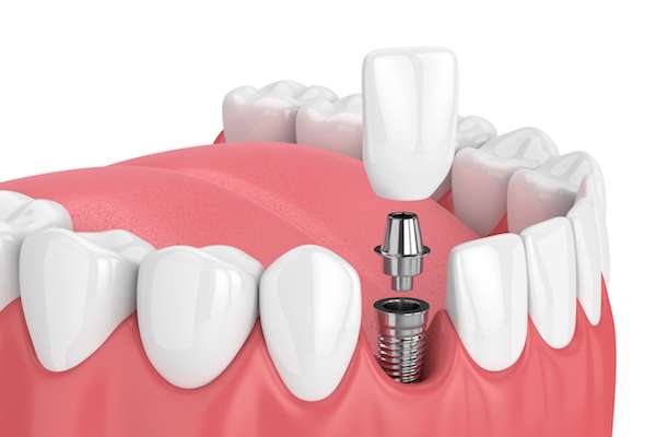 How Painful is Dental Implant Surgery from All Smiles Dental Center in San Antonio, TX