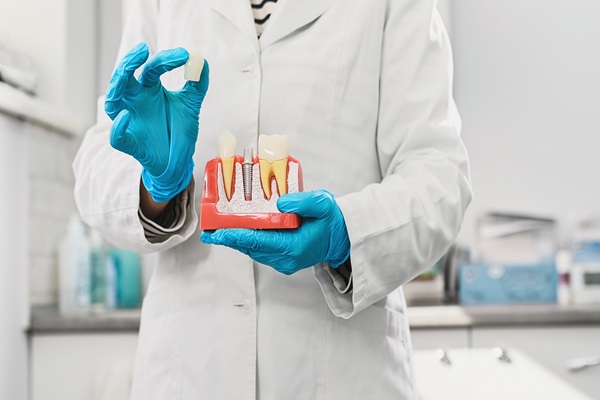 A Step By Step Guide To Getting An Implant Crown