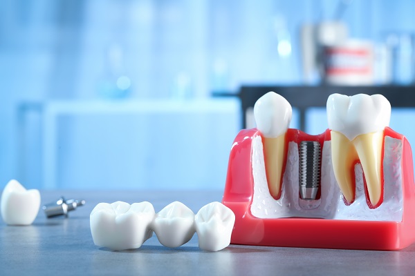 How Traditional Dental Crowns And Implant Crowns Differ