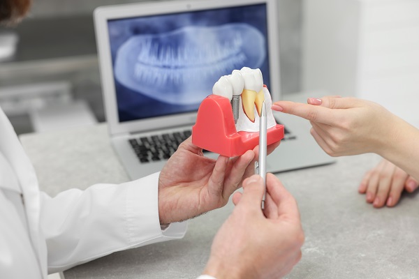 An Overview Of Implant Dentistry Treatment