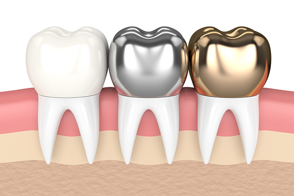 Metal Crowns vs. Porcelain Dental Crowns from All Smiles Dental Center in San Antonio, TX