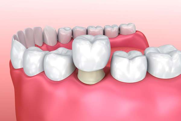 Permanent Dental Crowns vs. Temporary: Is There a Difference from All Smiles Dental Center in San Antonio, TX