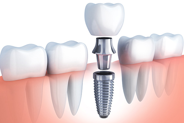 Questions to Ask Your Implant Dentist from All Smiles Dental Center in San Antonio, TX