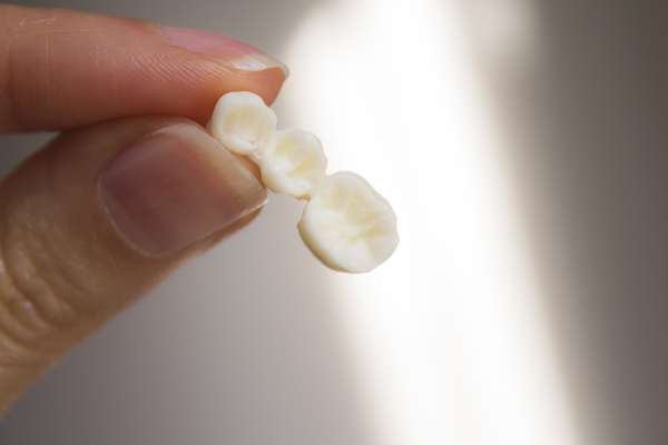 Replace Missing Teeth with Dental Bridges from All Smiles Dental Center in San Antonio, TX