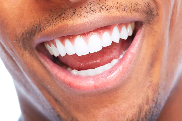 What A Smile Makeover Can Do For A Gummy Smile