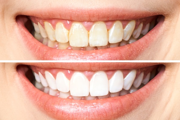 Teeth Whitening Treatment From Your Dentist