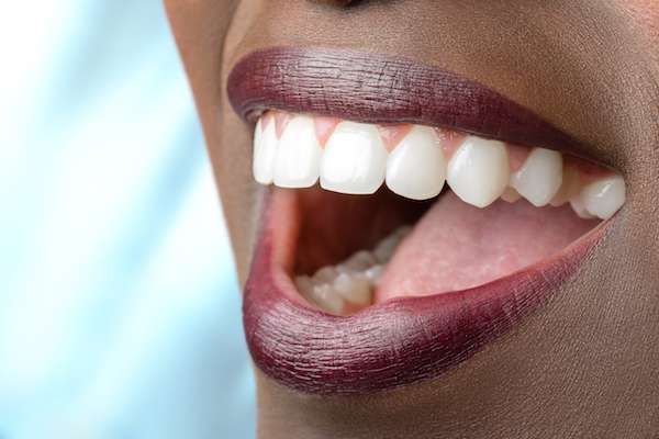 Routine Dental Care: What Are Tooth Colored Fillings from All Smiles Dental Center in San Antonio, TX